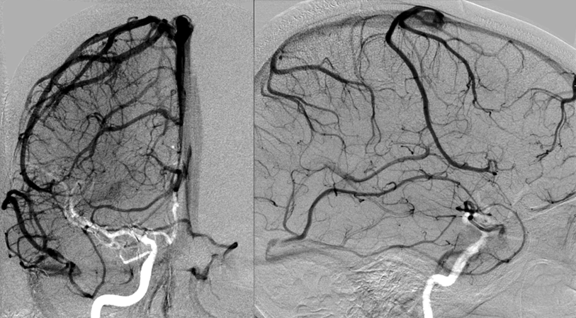 http://www.neuroangio.org/wp-content/uploads/Venous/V_anterior_cerebral_vein.png